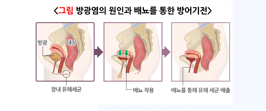 방광염56