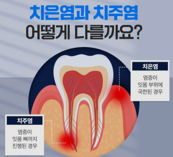 치은염과 치주염 차이