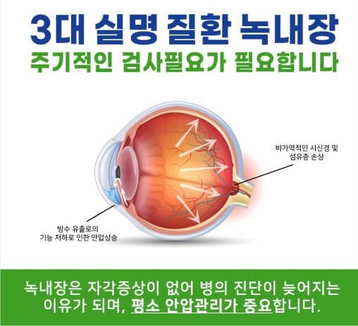 녹내장