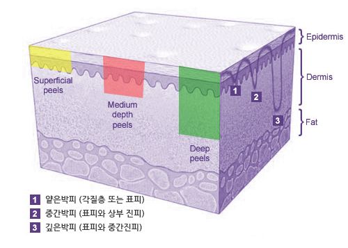 백반증 초기증상