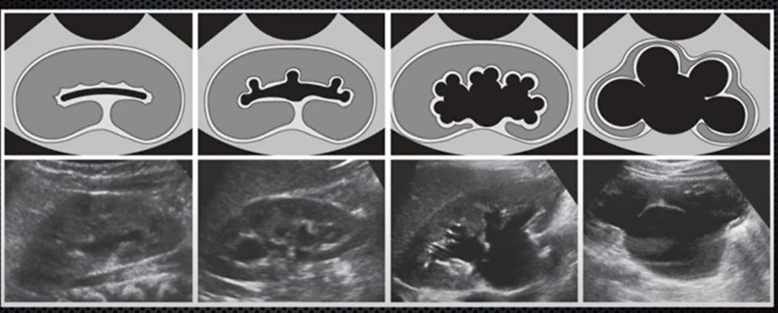  콩팥(신장) 장애 '수신증'의 모든 것!(hydronephrosis)