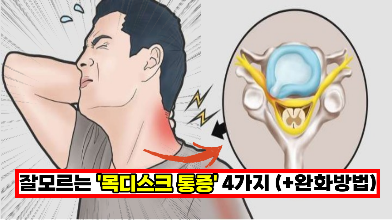  사람들이 목통증으로 알고 있는 가장 결정적인 '거북목 목디스크 통증' 4가지 (+완화하는 방법)
