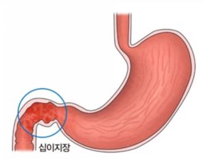 십이지장염 사진