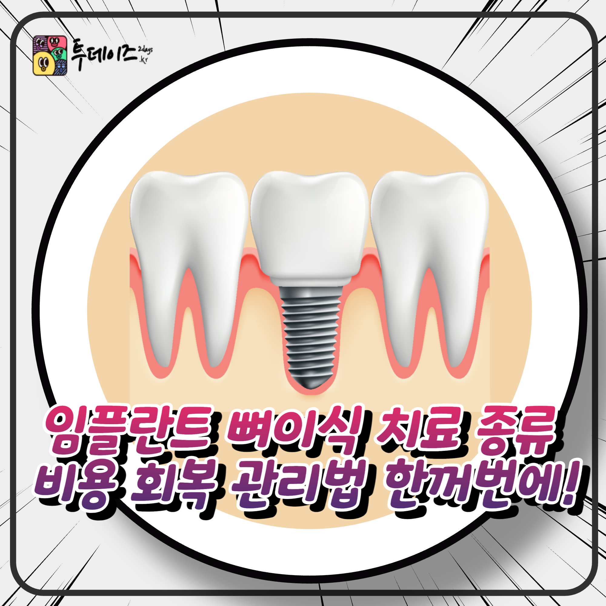 임플란트 뼈이식 치료 종류 비용 회복 관리법 한꺼번에!