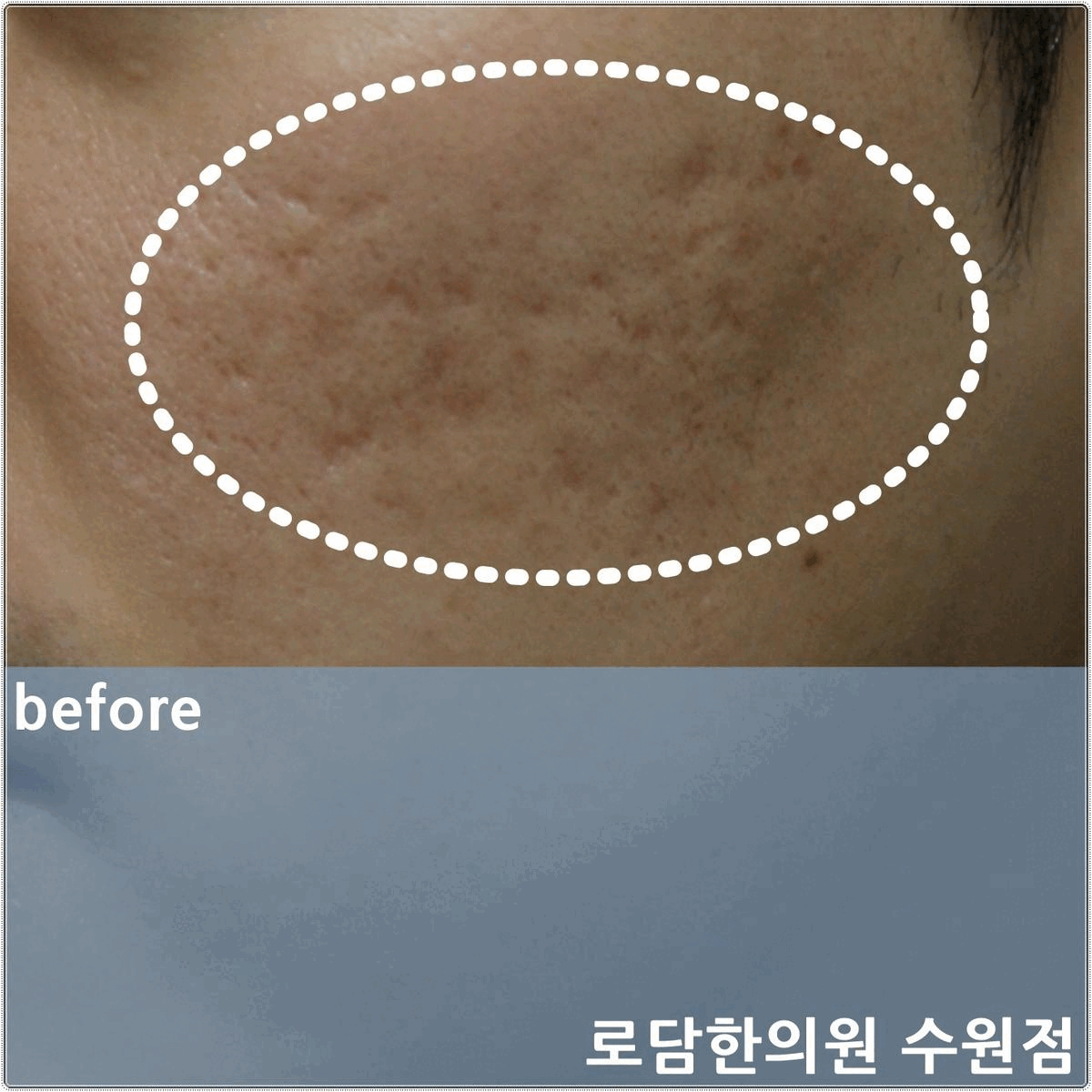  여드름 흉터 피부과 아닌 한의원에서 새살침 파인 흉터 치료