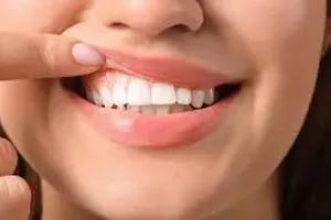 치아