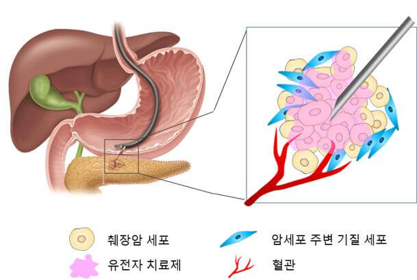 췌장암 초기증상