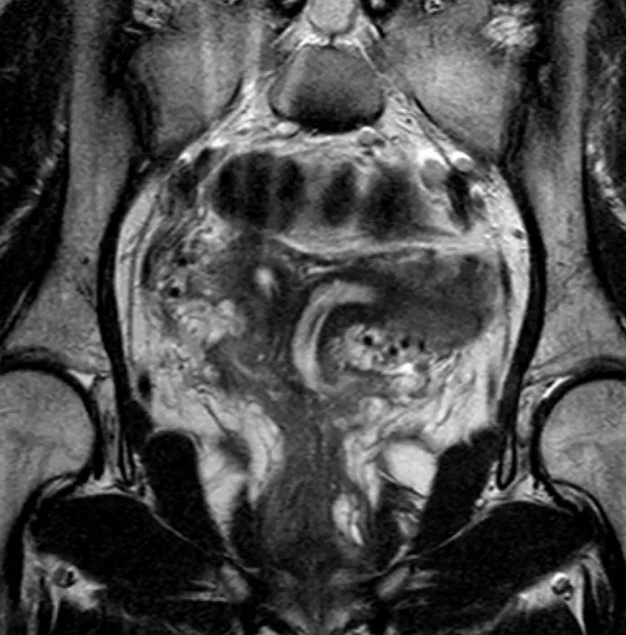 중복자궁의 MRI