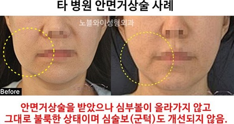  노블와이성형외과의원 안면거상재수술 전문?