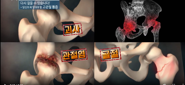 명의-고관절 통증