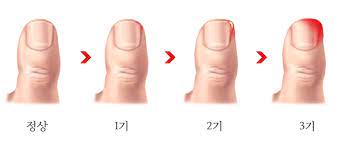 내성(내성) 손톱의 원인 및 초기 염증 증상, 그리고 자가 치료 2