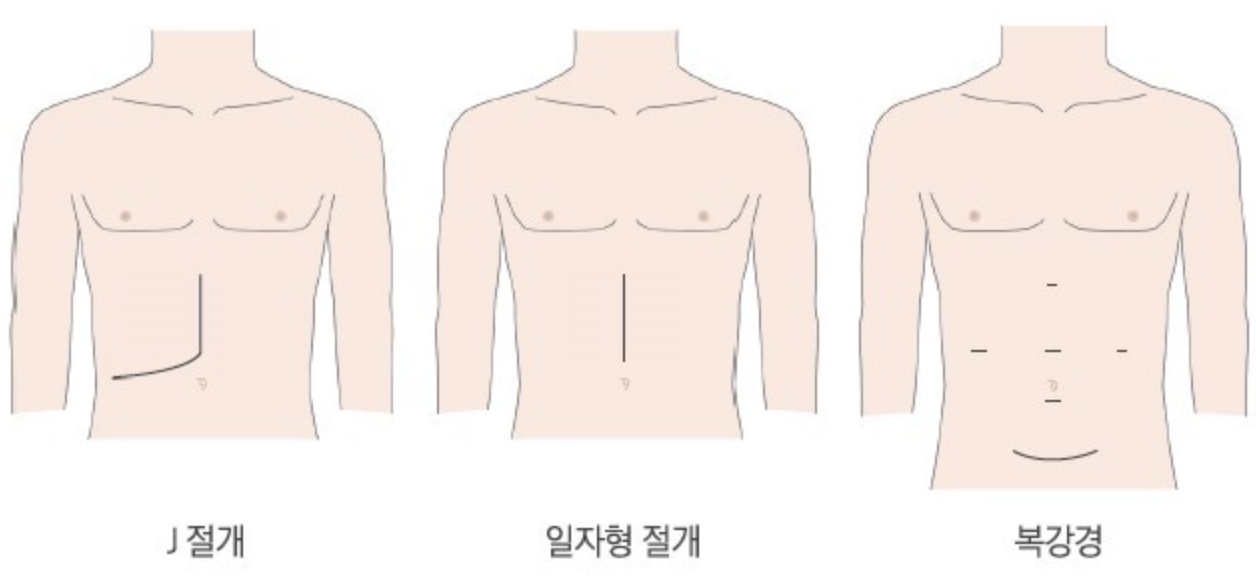  [간이식 수술] Ch.3 - 수술 방법•상처•흉터  (2:1 간이식)