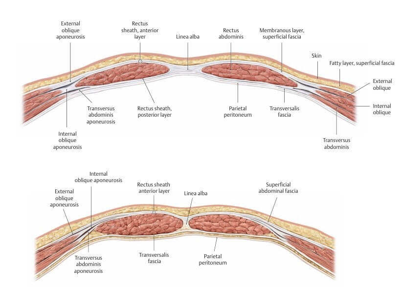 복횡근&#44; 내복사근&#44; 외복사근의 근막과 복직근의 연결을 보여주는 그림