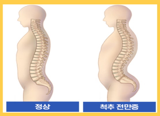 허리통증 원인