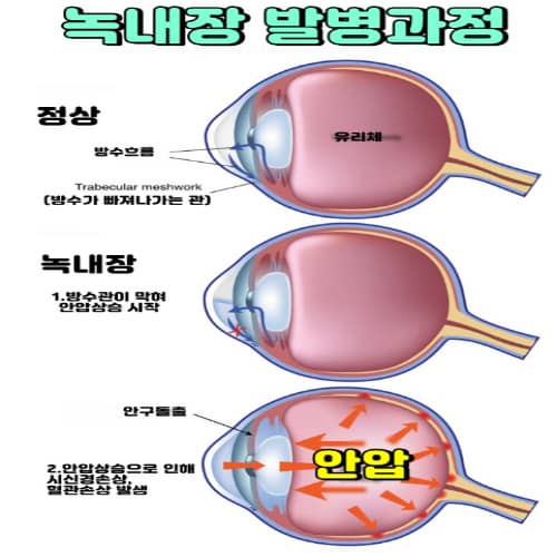 녹내장 발병과정