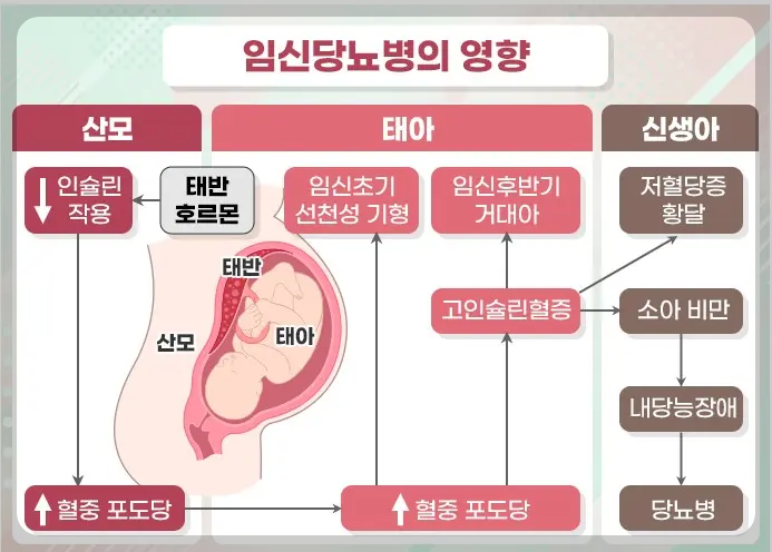 임신성 당뇨병의 태아 영향