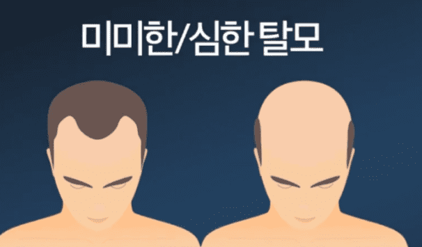  탈모 샴푸 효과 있을까?? / 탈모 예방방법 치료 원인 총정리