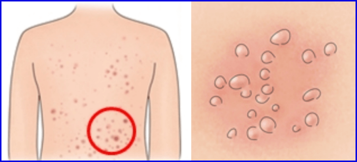 대상포진은 전염성이 있습니까?