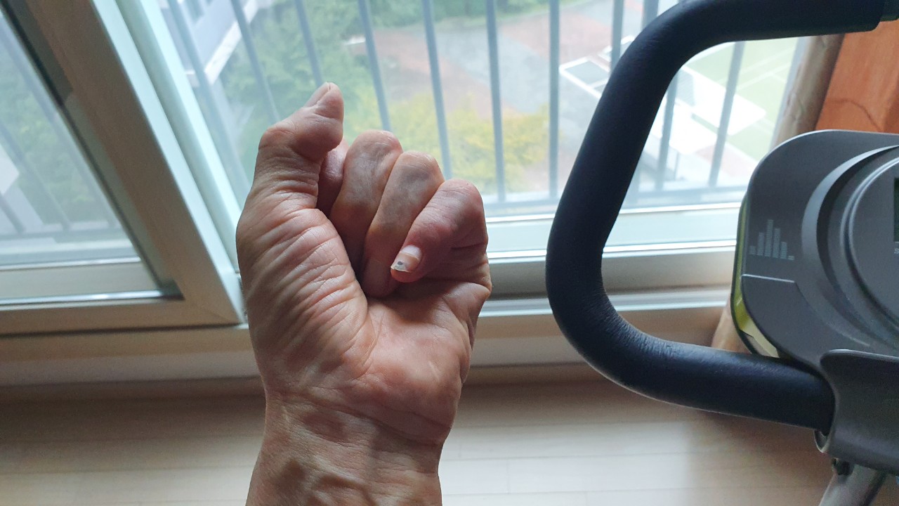 [낙상사고 투병기 176] 1타4피 1