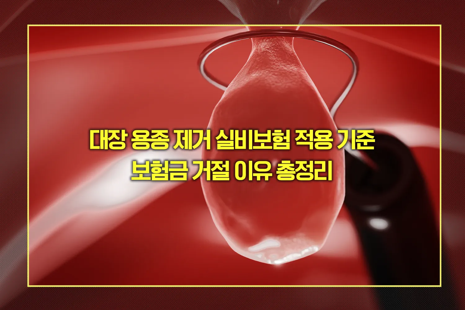 대장 용종 제거 실비보험 적용 기준