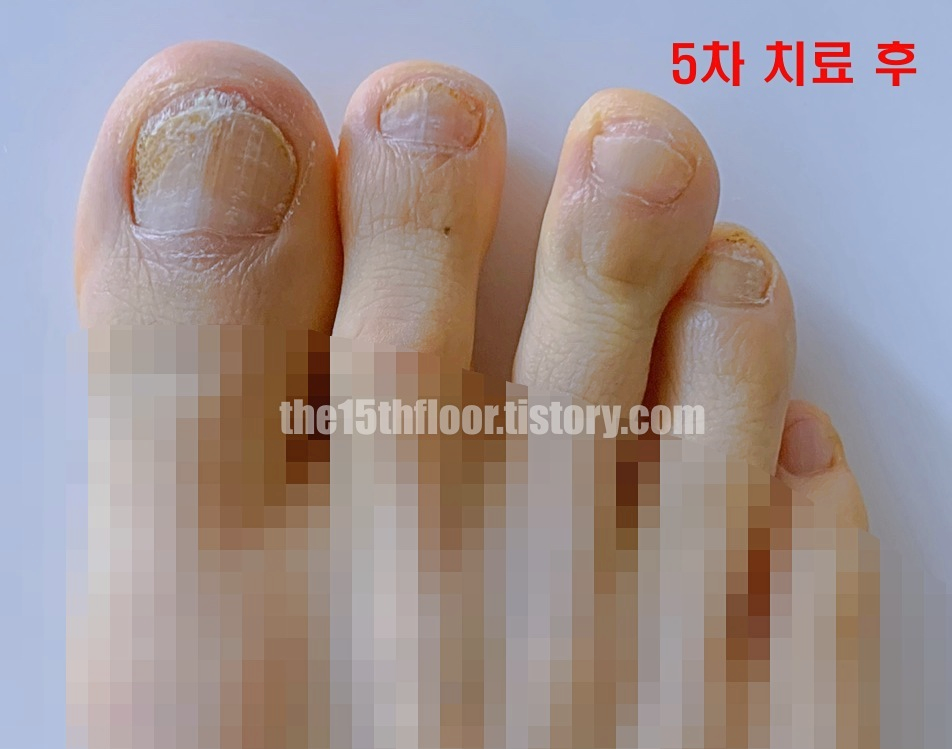 발톱무좀 치료 과정 (5차 치료 후)