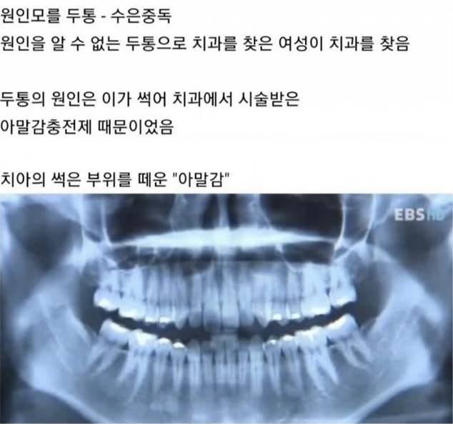  원인모를 두통에 시달리면 아말감을 의심
