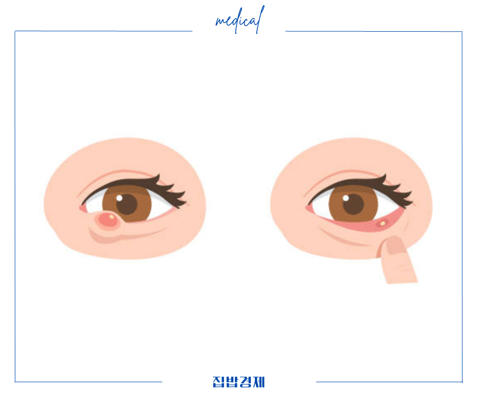 다래끼