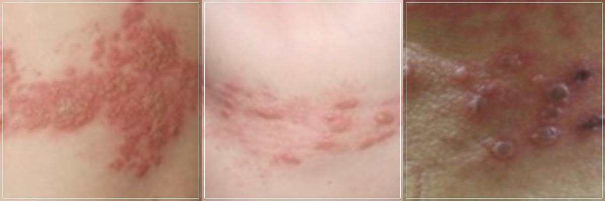  대상포진 초기증상 및 원인, 전염, 대상포진 치료 및 예방접종