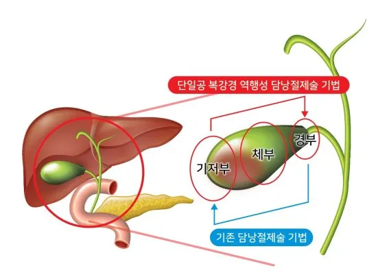 담낭 제거 수술후 먹지말아야할 음식