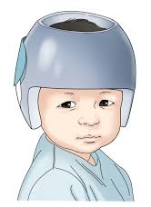 두상 교정 헬멧 예시 그림. 아이의 머리 모양에 따라 다른 형태의 헬멧을 제작합니다.