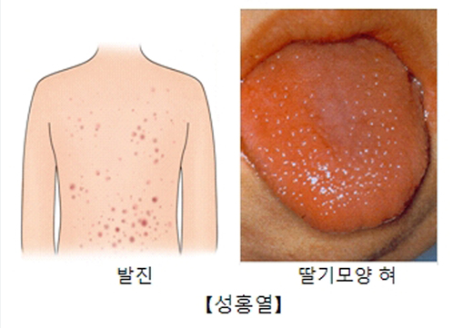 성홍열 증상