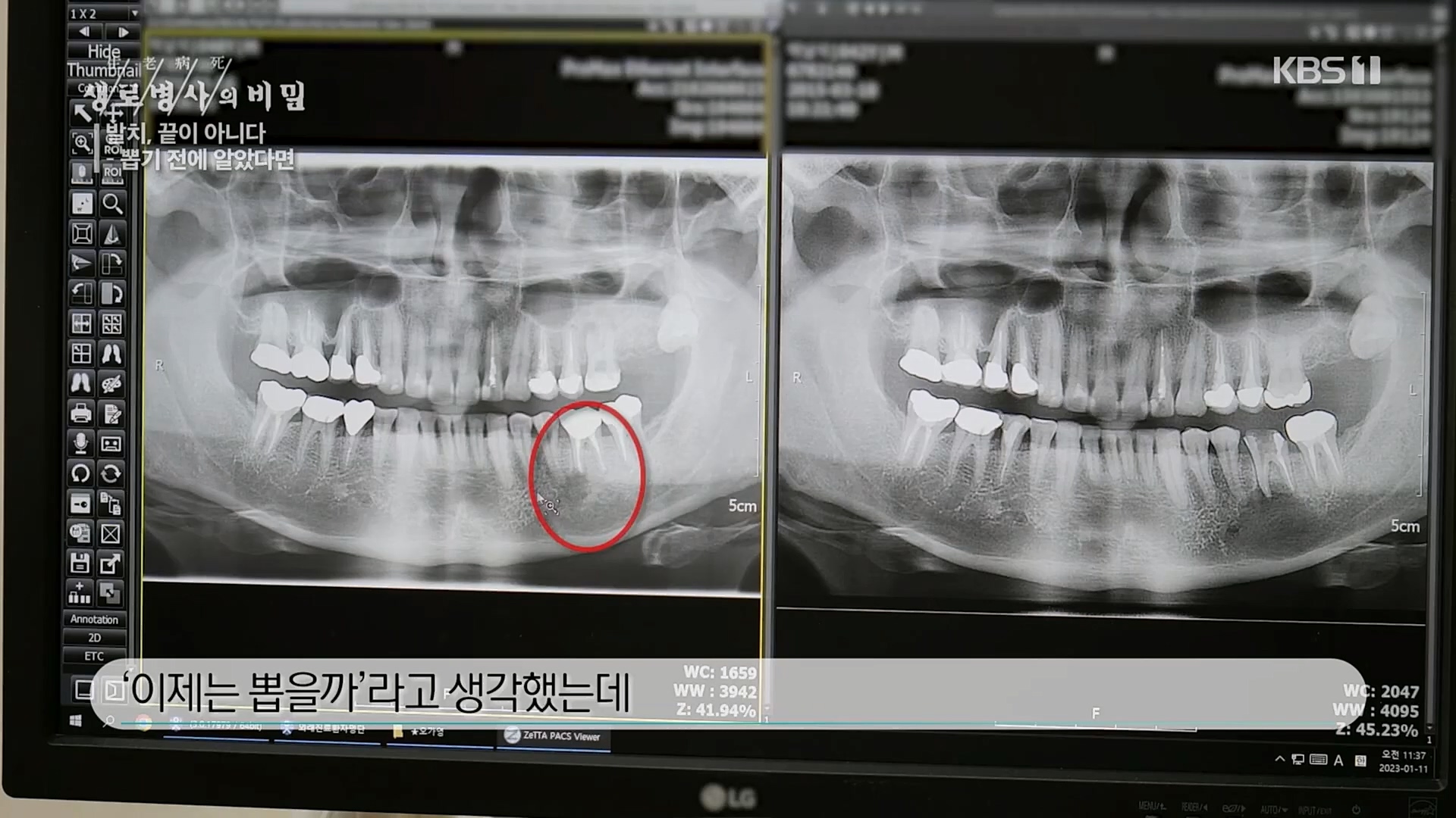 생로병사의 비밀.E855.230208p.H264-F1RST.mp4_20230214_194926.240.jpg