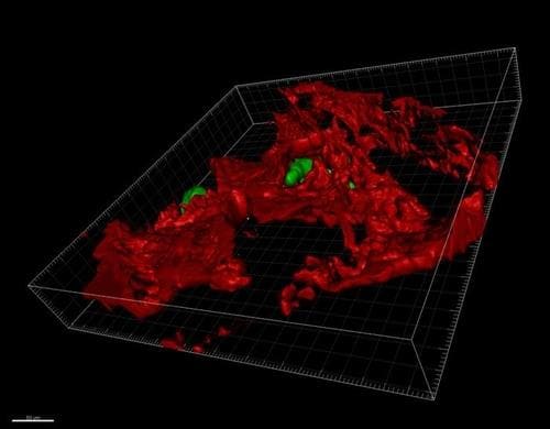  지방 많이 섭취하면 암 발병 가능성 높아져 Why Some Breast Cancer Cells Spread to Bone Tissue