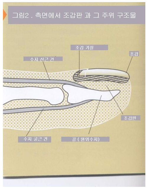조갑손상 사진출처 대한 정형외과 학회 홈페이지