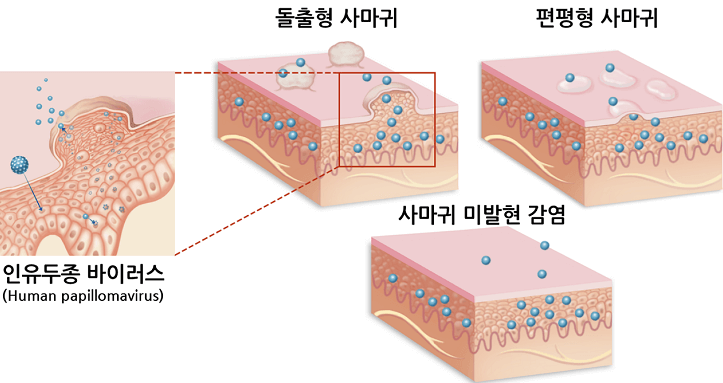 인유두종-바이러스-사마귀