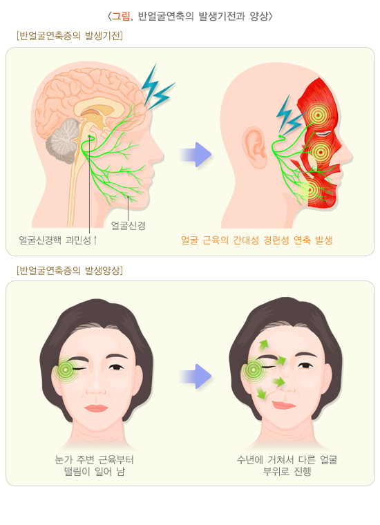 반얼굴연축의 발생기전과 양상