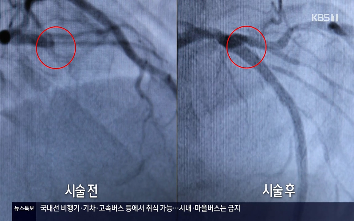 생로병사의 비밀.E820.220428p-NEXT.mp4_20220501_185247.928.jpg