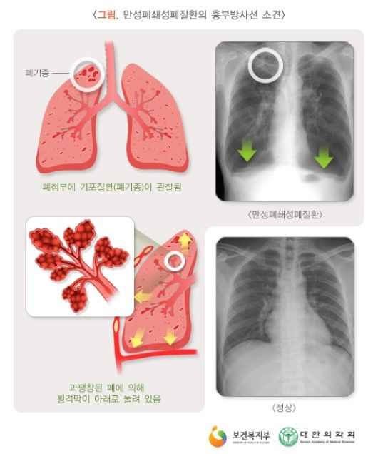 만성폐쇄성폐질환