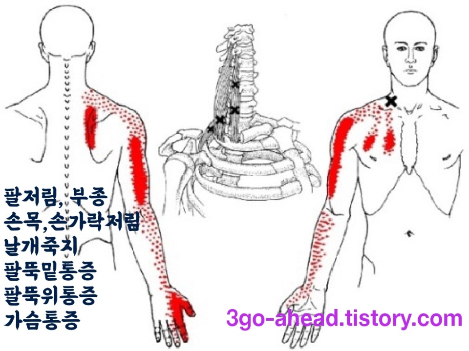 오른팔 저림 원인은?