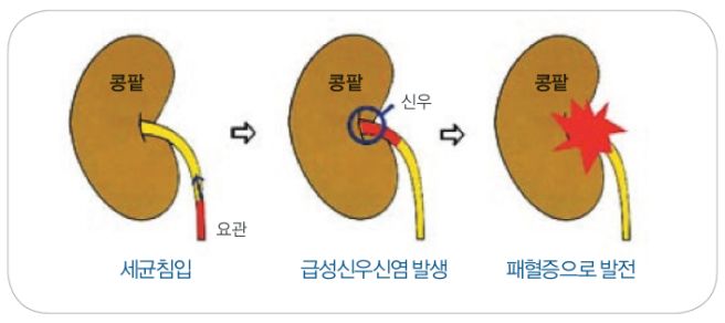 급성 신우신염 증상