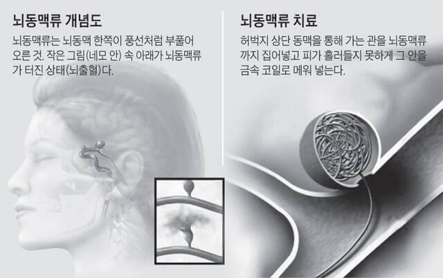 뇌동맥류 증상