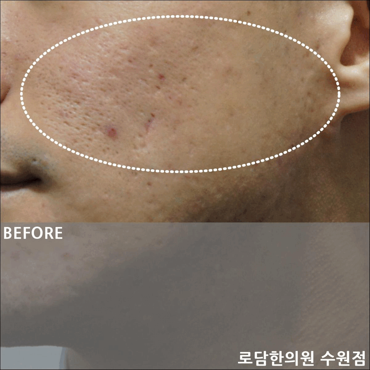  수원 여드름 흉터 아이스픽 자국 치료 과정 로담한의원 새살침