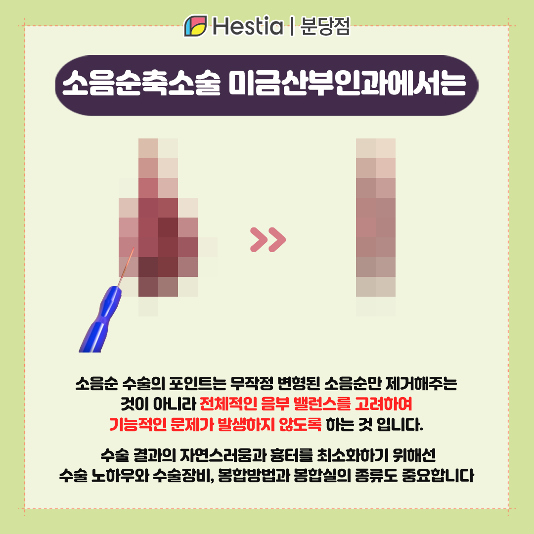 소음순늘어남 미금산부인과 소음순축소술 미금산부인과의 소음순축소술은?