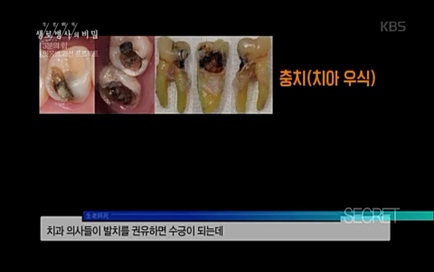 [670회] 생로병사의 비밀 - KBS670회] 생로병사의 비밀.ts_20220505_143203.277.jpg