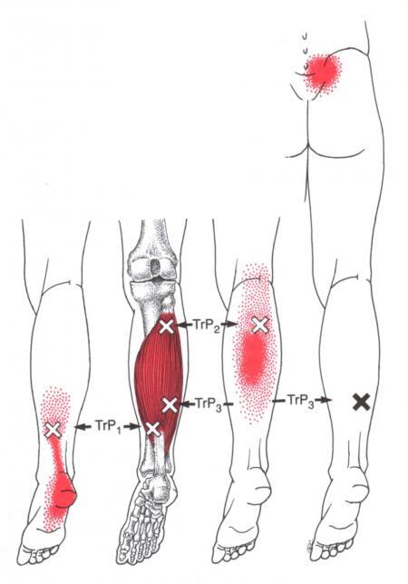 비장근 (Soleus) 통증 유발점 위치