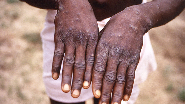  [Monkeypox Virus]의 증상, 치료 및 예방 가이드