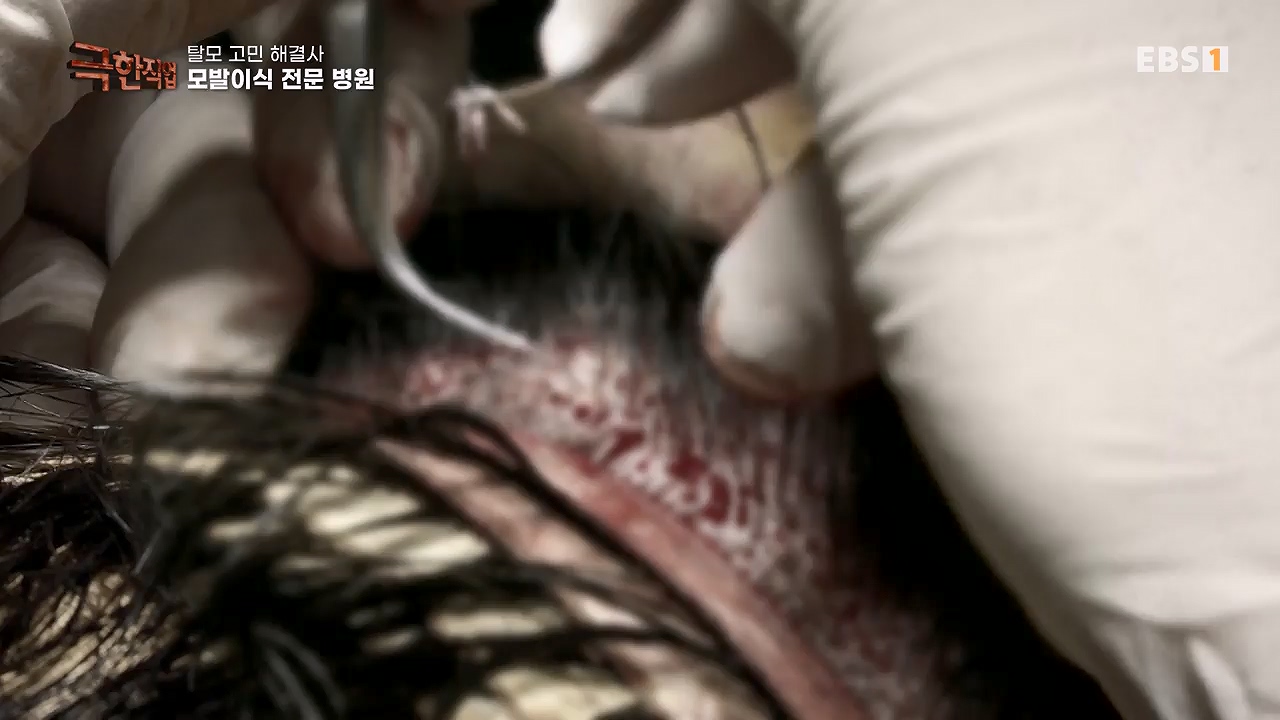 TV - 전 국민의 평생학교 EBS탈모 고민 해결사.mp4_20230508_195806.068.jpg