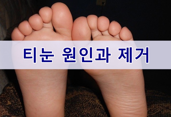  발바닥 티눈 생기는이유와 제거방법