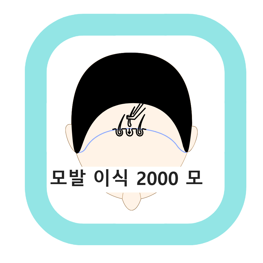  비절개 모발 이식, 절개 모발 이식 2000 모 이상은 필수 합리적인 가격