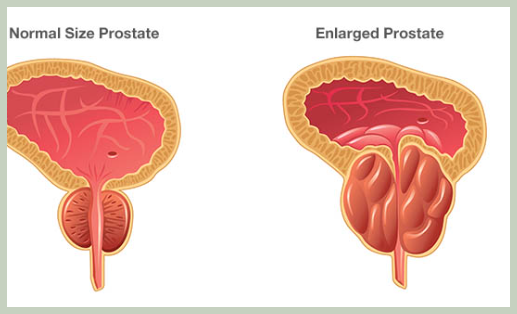 전립선비대증의 이해